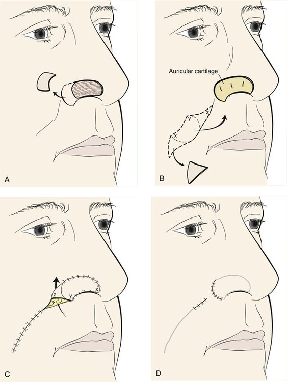 Melolabial Flap (ML)