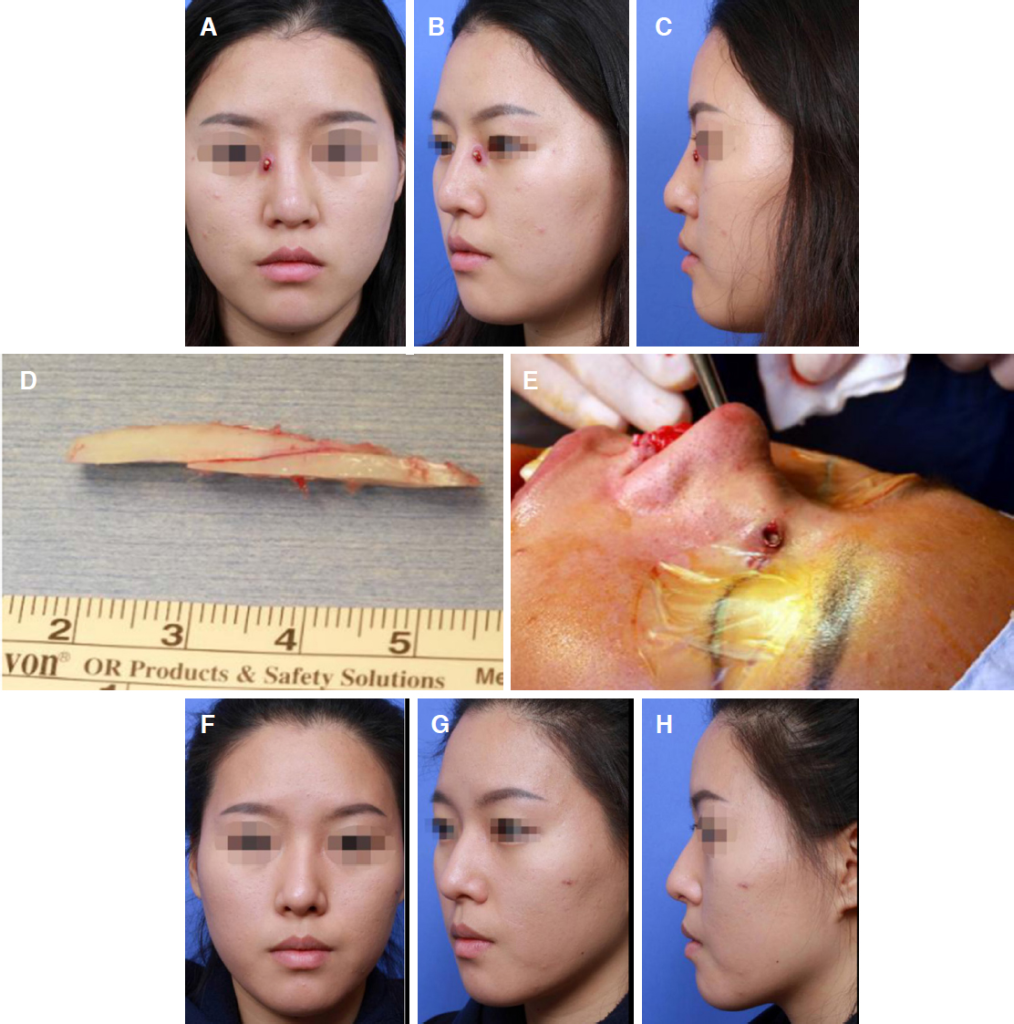 Auto Rib Cartilage (ARC) Rhinoplasty