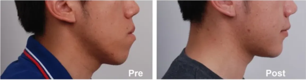 Bimaxillary Lower Jaw Surgery as part of our Facial Contouring Surgery