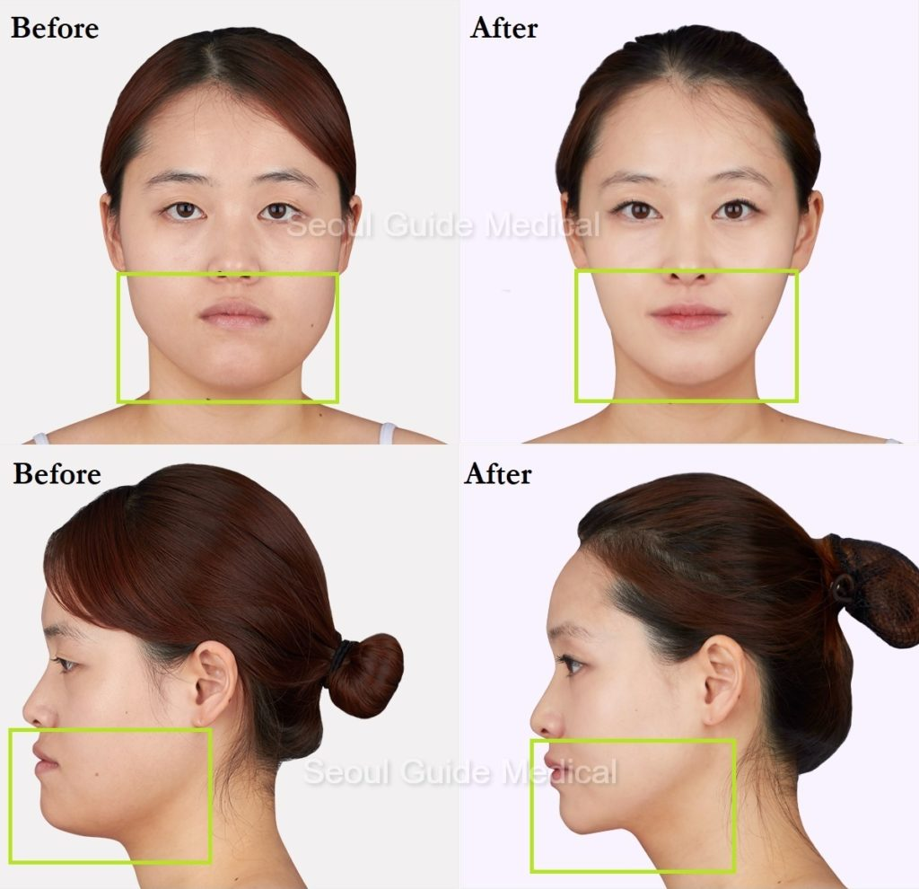 Bimaxillary (Two-Jaw) Surgery as part of our Facial Contouring Surgery
