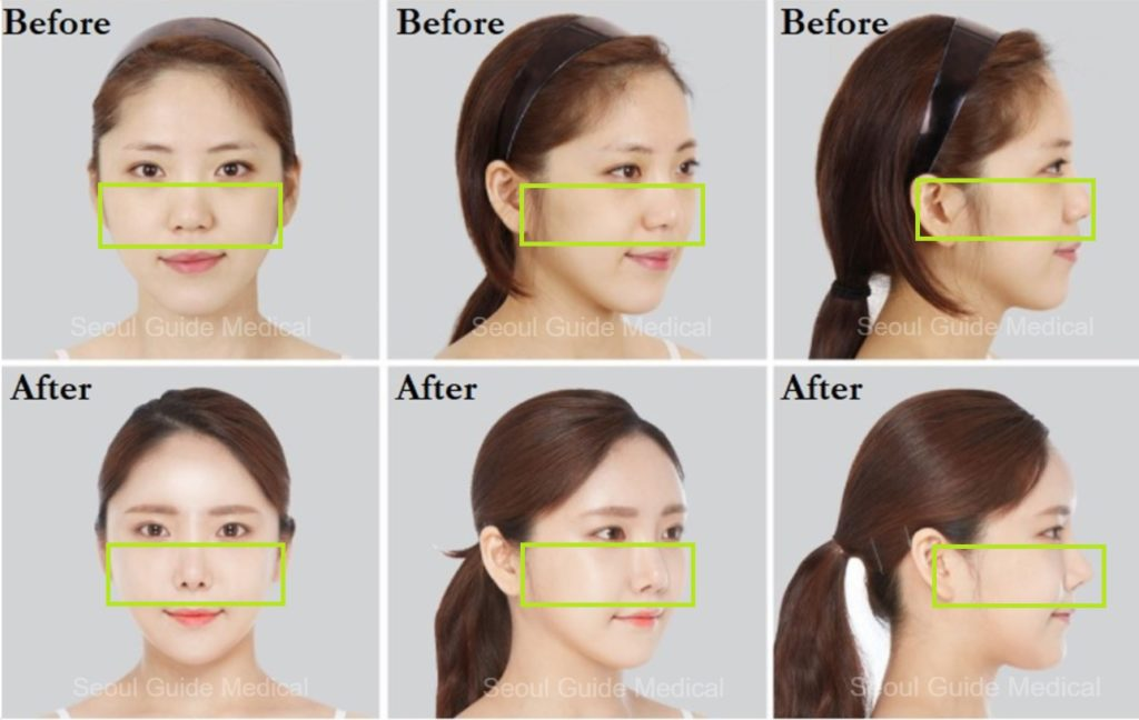 Zygoma Reduction (Cheekbone Reduction) as part of our Facial Contouring Surgery