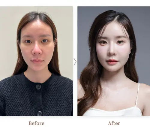 Angle Reduction (Mandibular Angle Reduction / V-line Jaw Surgery) as part of our Facial Contouring Surgery