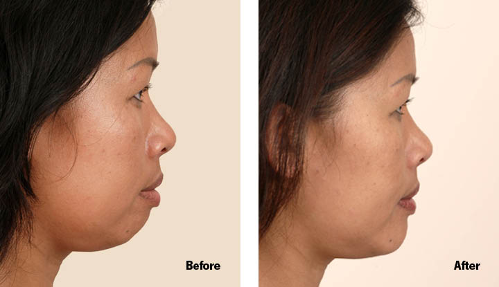 Genioplasty (Chin Surgery) 