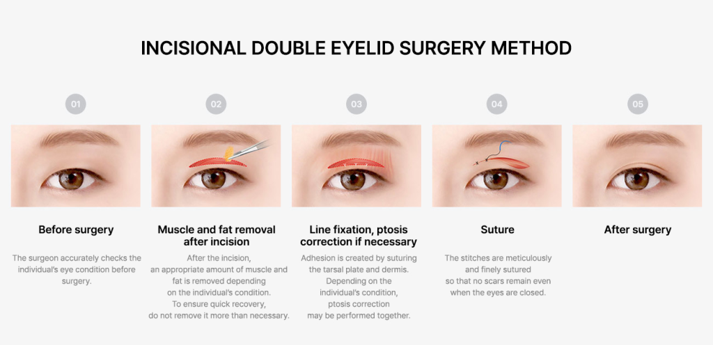 Eye Cosmetic Surgery :  Incisional Upper Blepharoplasty