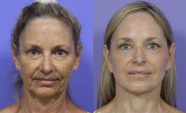 Face Lift (F/L) 