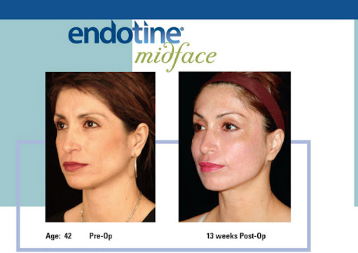 Endotine Face Lift (F-ENDO) 