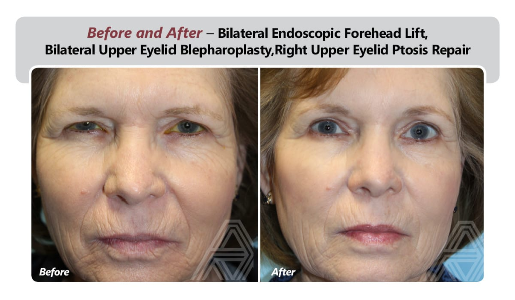 Forehead Lift (FHL) 