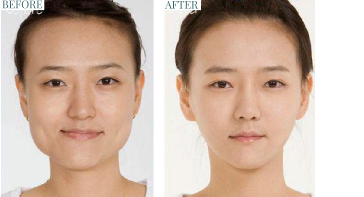 Facial Contouring Surgery : Botox / Neurotoxin Injections for Jaw Slimming