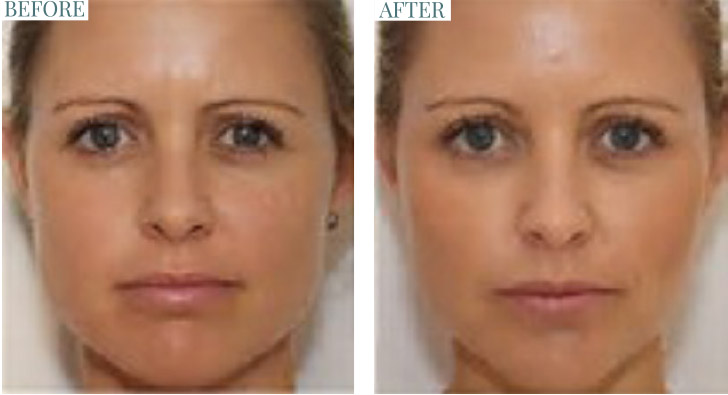 Facial Contouring Surgery  : Botox can reduce jaw width, giving a softer, V-shaped appearance.