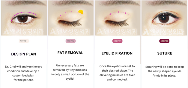 Eye Cosmetic Surgery : Partial Incisional Double Eyelid Surgery