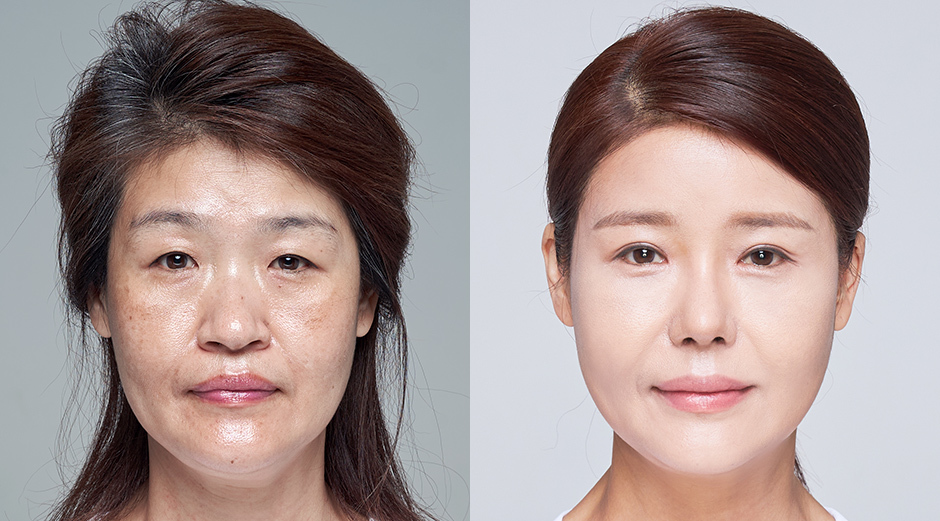Endotine Forehead Lift (FH ENDO)