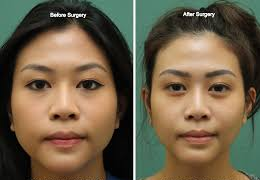 V-Line Jaw Reduction + Chin Genioplasty