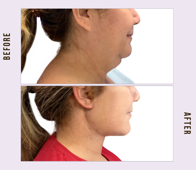 Face & Neck Lift (FNL) 