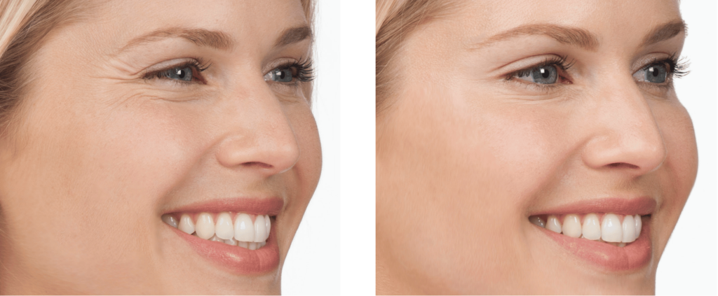 Skin Care & Laser Dermatology : Forehead lines & crow’s feet Botox 
