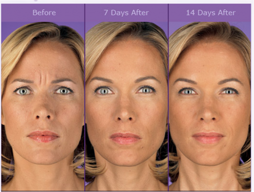 Skin Care & Laser Dermatology :  Glabella (frown lines) Botox 