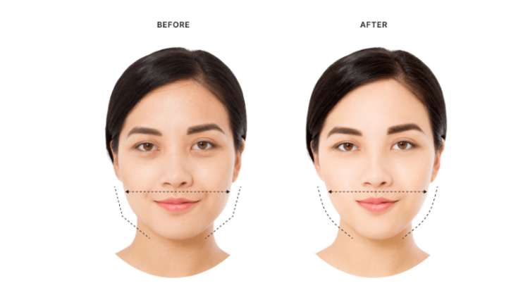 Skin Care & Laser Dermatology :  Masseter (jaw muscle) Botox