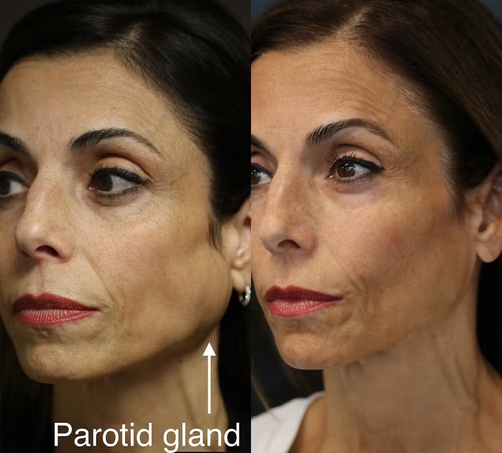 Skin Care & Laser Dermatology :  Salivary glands Botox : Reduces facial bulk for a more elegant profile.