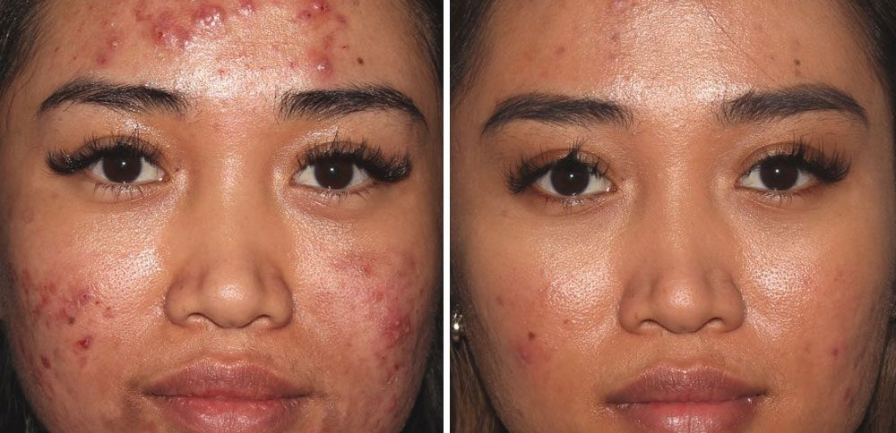 Skin Botox (micro-BTX): Shrinks pores, reduces oil, and tightens skin for a glass-skin effect.