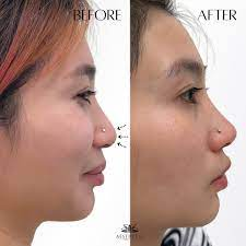 Nose bridge & tip dermafillers