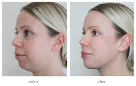 Skin Care & Laser Dermatology : Jawline & chin Dermafillers