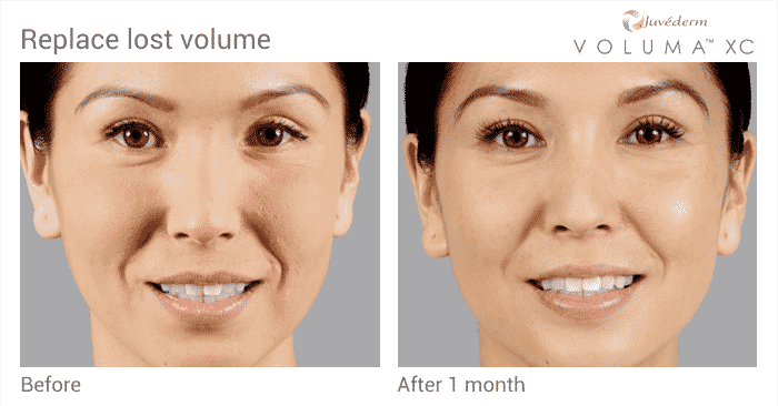 Facial surgery's Hyaluronic acid fillers (e.g. Juvéderm Voluma) for midface volume deficiency show that: ~96% were responders at 2 months