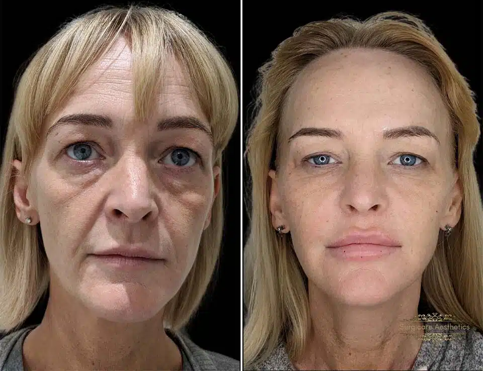 Skin Care & Laser Dermatology :  Nasolabial folds & marionette line dermafillers