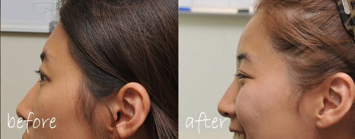 Skin Care & Laser Dermatology :  Temples & forehead Dermafillers