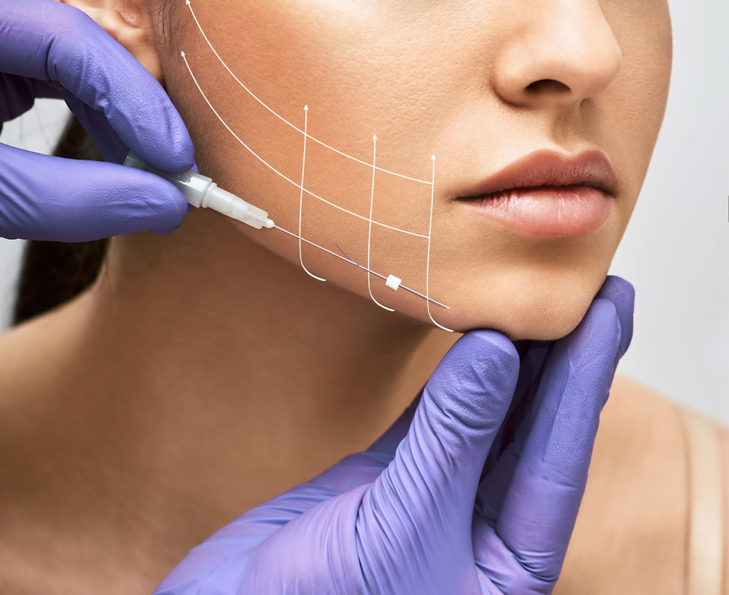Thread Lifting (Non-Surgical Lift)