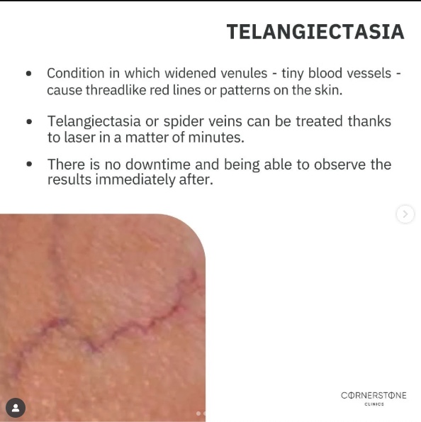 Telangiectasias (Spider Veins), are small, dilated blood vessels located near the surface of the skin or mucous membranes.