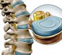 Intervertebral discs are specialized fibrocartilaginous structures located between the vertebrae in the spine. They act as cushions or shock absorbers, helping to protect the vertebrae during movement such as bending, twisting, and walking. There are 23 discs in the human spine: 6 cervical, 12 thoracic, and 5 lumbar.