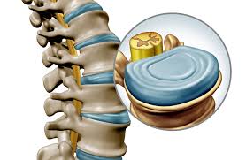 Intervertebral discs are specialized fibrocartilaginous structures located between the vertebrae in the spine. They act as cushions or shock absorbers, helping to protect the vertebrae during movement such as bending, twisting, and walking. There are 23 discs in the human spine: 6 cervical, 12 thoracic, and 5 lumbar.