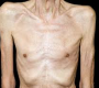 Cachexia is a complex metabolic syndrome characterized by severe muscle wasting (sarcopenia) and fat loss that cannot be fully reversed by conventional nutritional support.