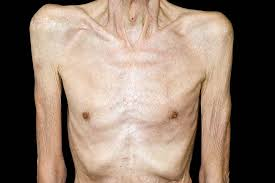 Cachexia is a complex metabolic syndrome characterized by severe muscle wasting (sarcopenia) and fat loss that cannot be fully reversed by conventional nutritional support.