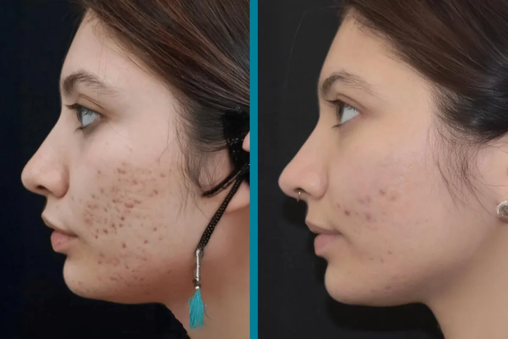 Cellular Therapy and Stem Cells for Acne Scarring represent a transformative advancement in regenerative dermatology, offering hope to individuals burdened by disfiguring post-acne scars that resist conventional treatments. 