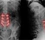 Failed Back Surgery Syndrome (FBSS) refers to a condition where patients experience persistent or recurrent pain following one or more back or spine surgeries. Despite surgical intervention aimed at relieving pain or correcting spinal problems, symptoms continue or worsen, impacting quality of life123.