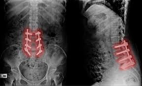 Failed Back Surgery Syndrome (FBSS) refers to a condition where patients experience persistent or recurrent pain following one or more back or spine surgeries. Despite surgical intervention aimed at relieving pain or correcting spinal problems, symptoms continue or worsen, impacting quality of life123.