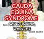 Cauda Equina Syndrome (CES) is a serious neurological condition caused by compression or damage to the bundle of nerve roots at the lower end of the spinal cord called the cauda equina.