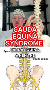 Cauda Equina Syndrome (CES) is a serious neurological condition caused by compression or damage to the bundle of nerve roots at the lower end of the spinal cord called the cauda equina.