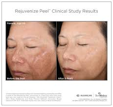 Chemical peels are medical procedures in which a chemical solution is applied to the skin, causing controlled injury or exfoliation of its layers.