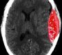 Epidural hematoma (EPH) is a collection of blood that forms between the outer membrane covering the brain or spinal cord (the dura mater) and the surrounding bone.