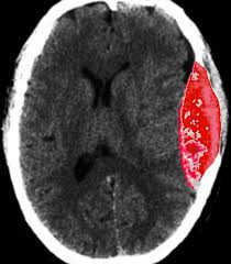 Epidural hematoma (EPH) is a collection of blood that forms between the outer membrane covering the brain or spinal cord (the dura mater) and the surrounding bone.