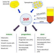 Stromal Vascular Fractions (SVFs) are a heterogeneous mixture of cells derived from adipose tissue (fat). These cells are not the same as stem cells but contain a high concentration of various cell types with regenerative potential, including mesenchymal stromal cells, endothelial progenitor cells, leukocytes, and pericytes.