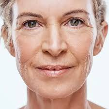 Sagging (Sg) refers to the loosening or drooping of the skin and underlying tissues commonly seen with aging.