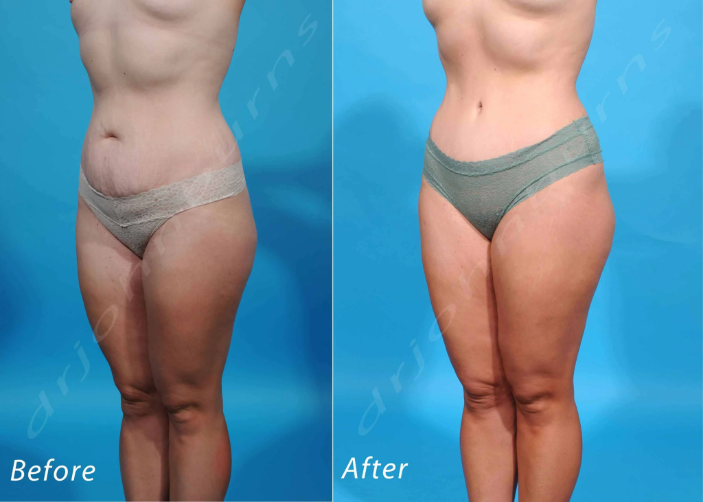 Liposuction (Liposculpture)  at PASCAL, KCCS in Gangnam, Seoul