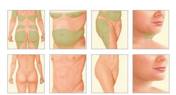 Body Contouring Surgery at PASCAL, KCCS in Gangnam, Seoul