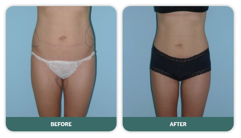 Hips and flanks (“love handles”) Liposuction (Liposculpture) at PASCAL, KCCS in Gangnam, Seoul