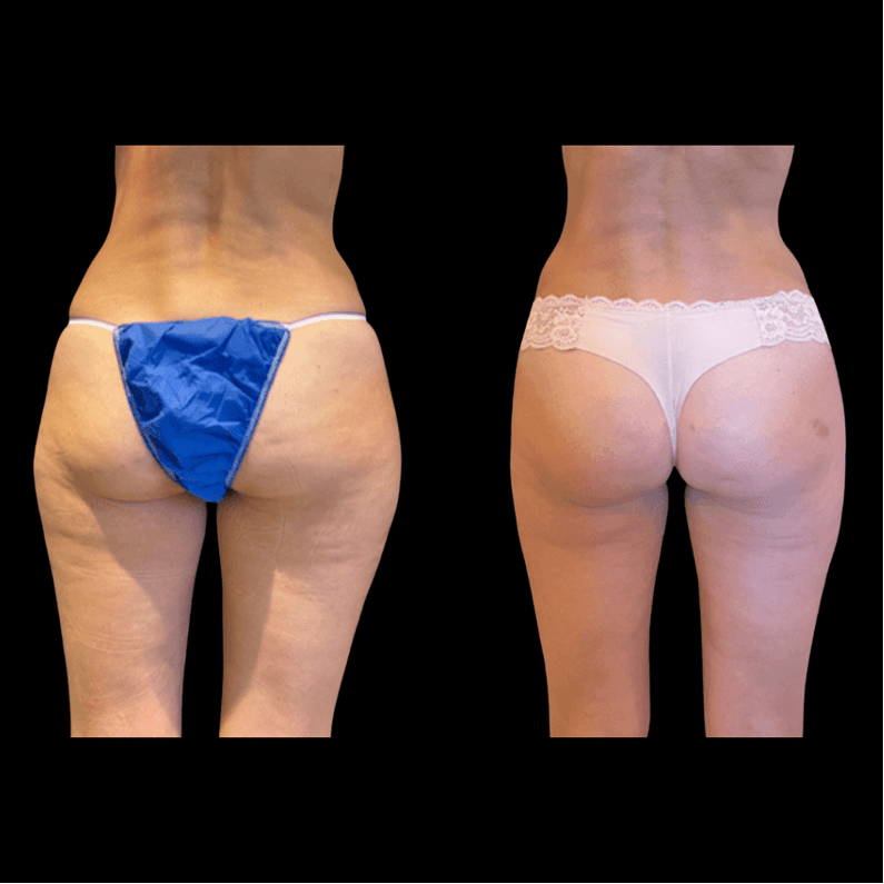Thighs (inner and outer) Liposuction (Liposculpture) at PASCAL, KCCS in Gangnam, Seoul