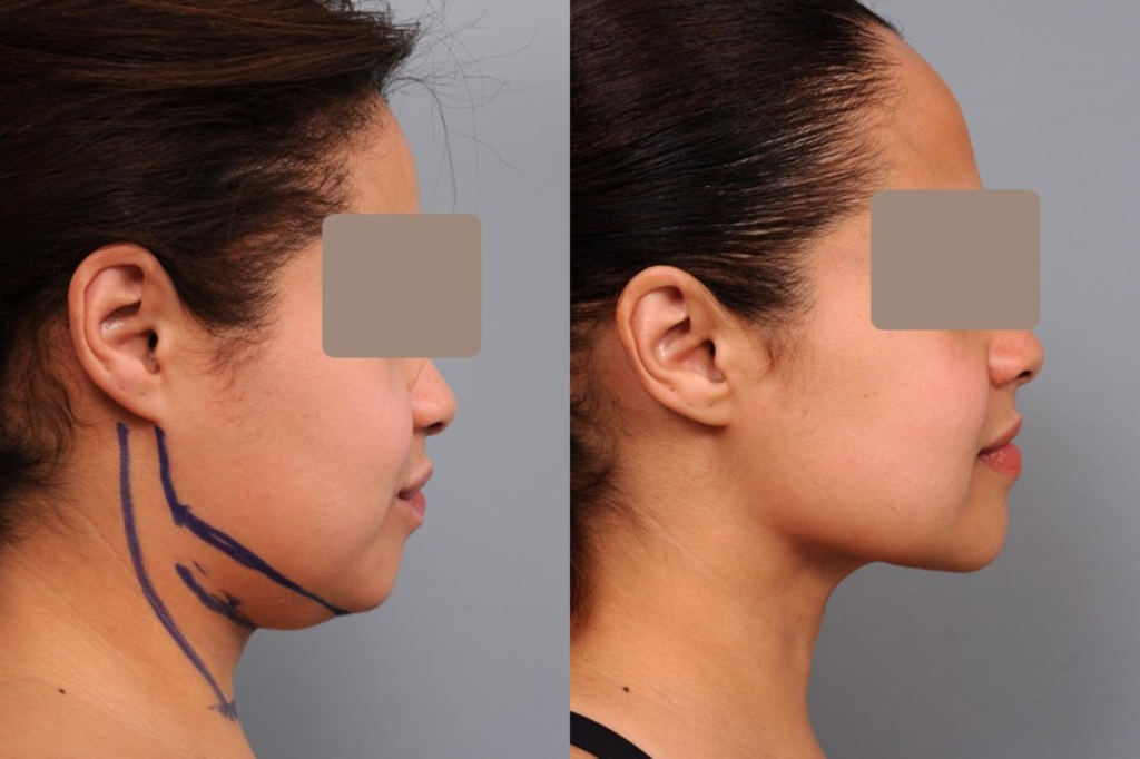 Chin and neck Liposuction (Liposculpture) at PASCAL, KCCS in Gangnam, Seoul