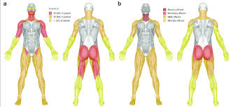 Muscular weakness, also known as myasthenia or muscle fatigue, refers to a reduced ability of a muscle to generate force. It can affect one muscle or many muscles and can be temporary or chronic. Weakness can be caused by neurological, muscular, or systemic conditions and may impact mobility, strength, and daily functioning.