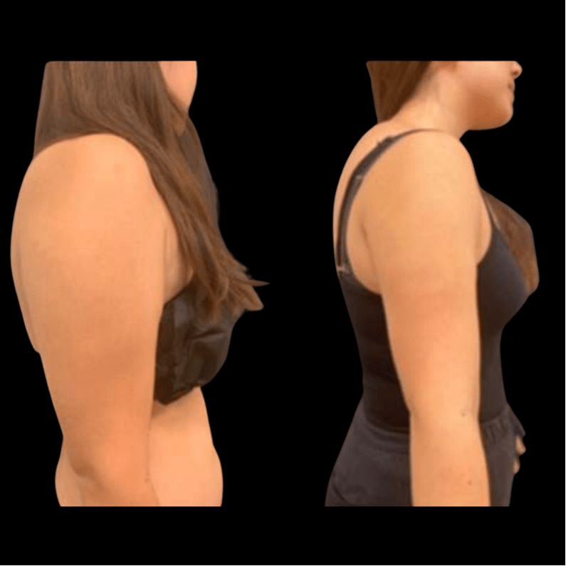 Upper arms Liposuction (Liposculpture) at PASCAL, KCCS in Gangnam, Seoul